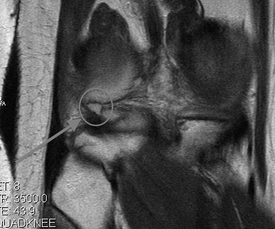 Loose Body Posterolateral Compartment